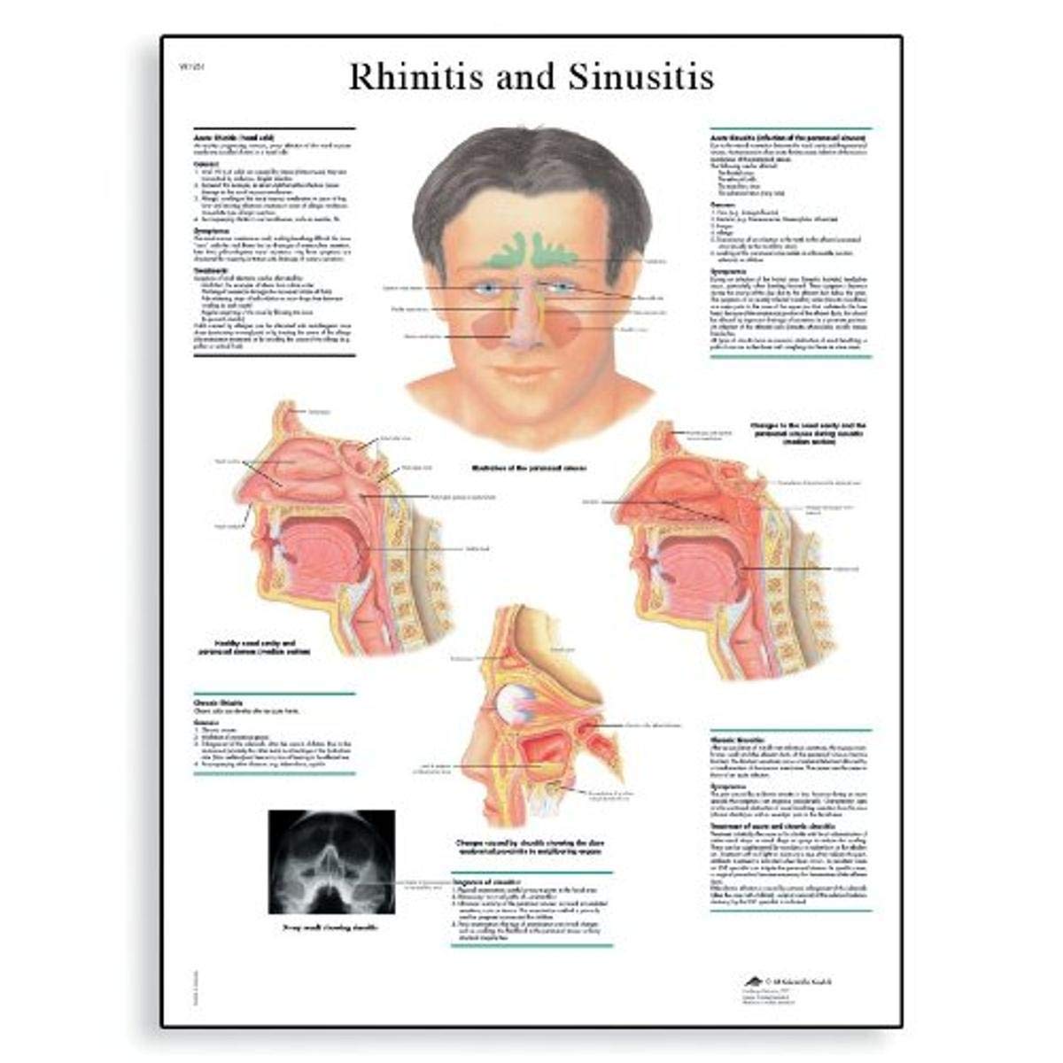 3B Scientific VR1251L Glossy Laminated Paper Rhinitis and Sinusitis Anatomical Chart, Poster Size 20" Width x 26" Height 1