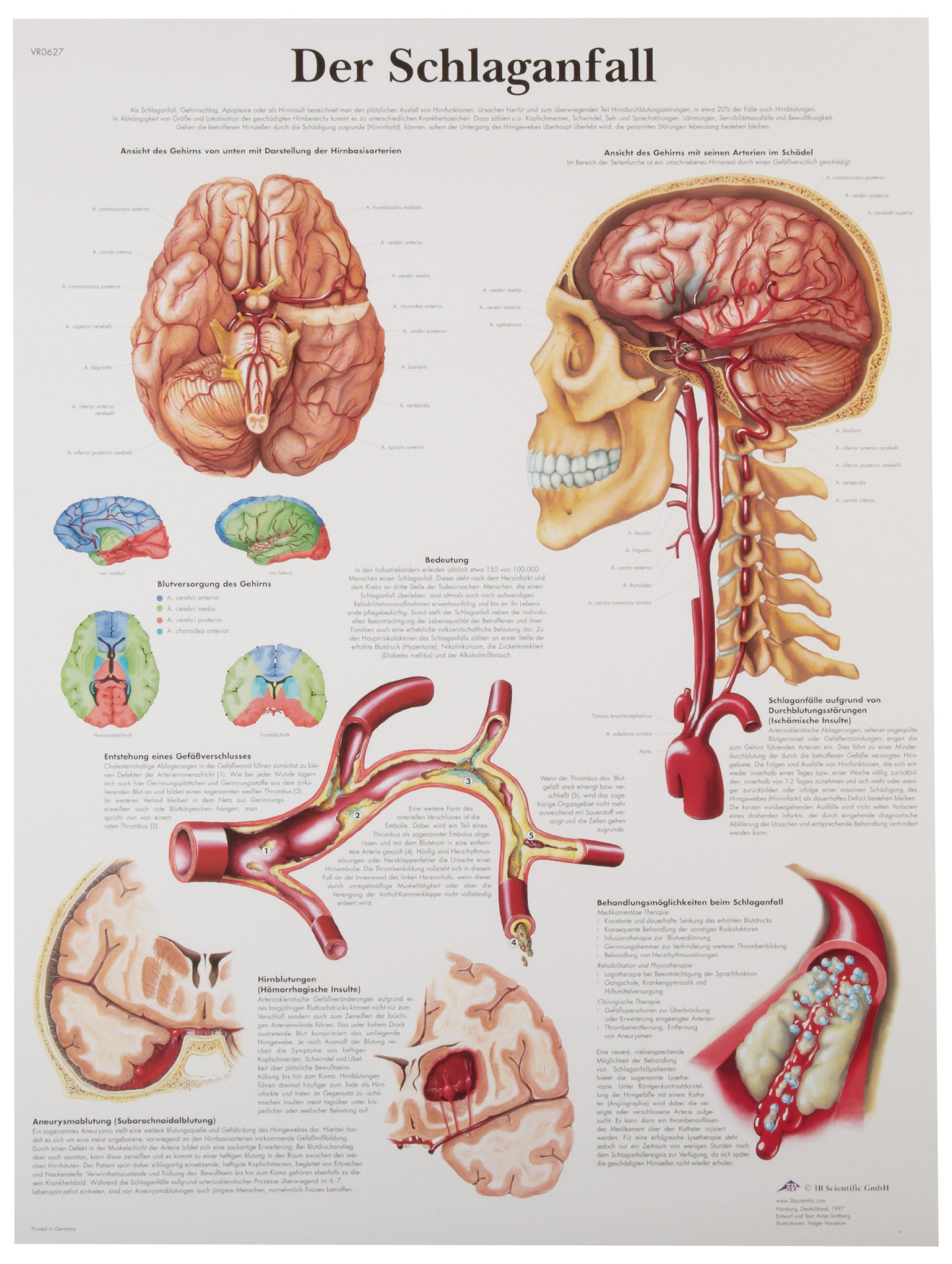 3B Scientific VR0627UU Glossy Paper Der Schlaganfall Anatomical (Stroke Anatomical Chart, German), Poster Size 20" Width x 26" Height